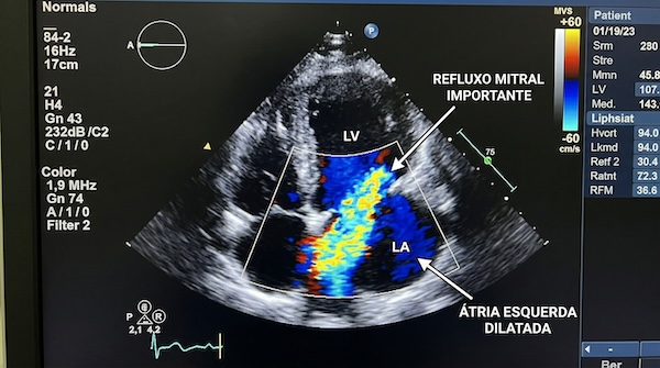 Ecocardiograma transtoracico com foco no fluxo cardiaco
